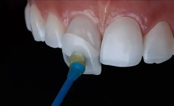 Smile Makeover with Veneers